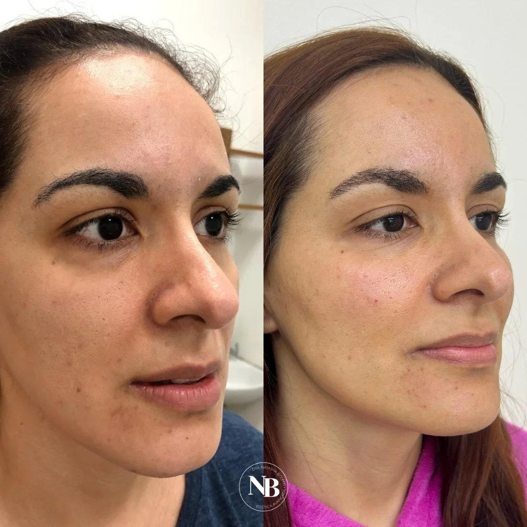 antes-depois-nb 03