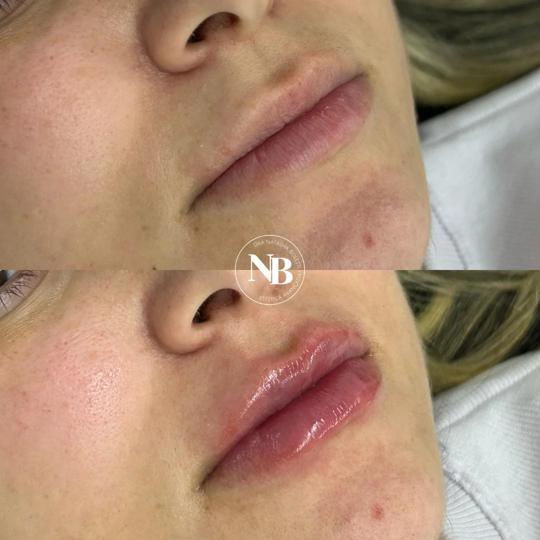 antes-depois-nb 04