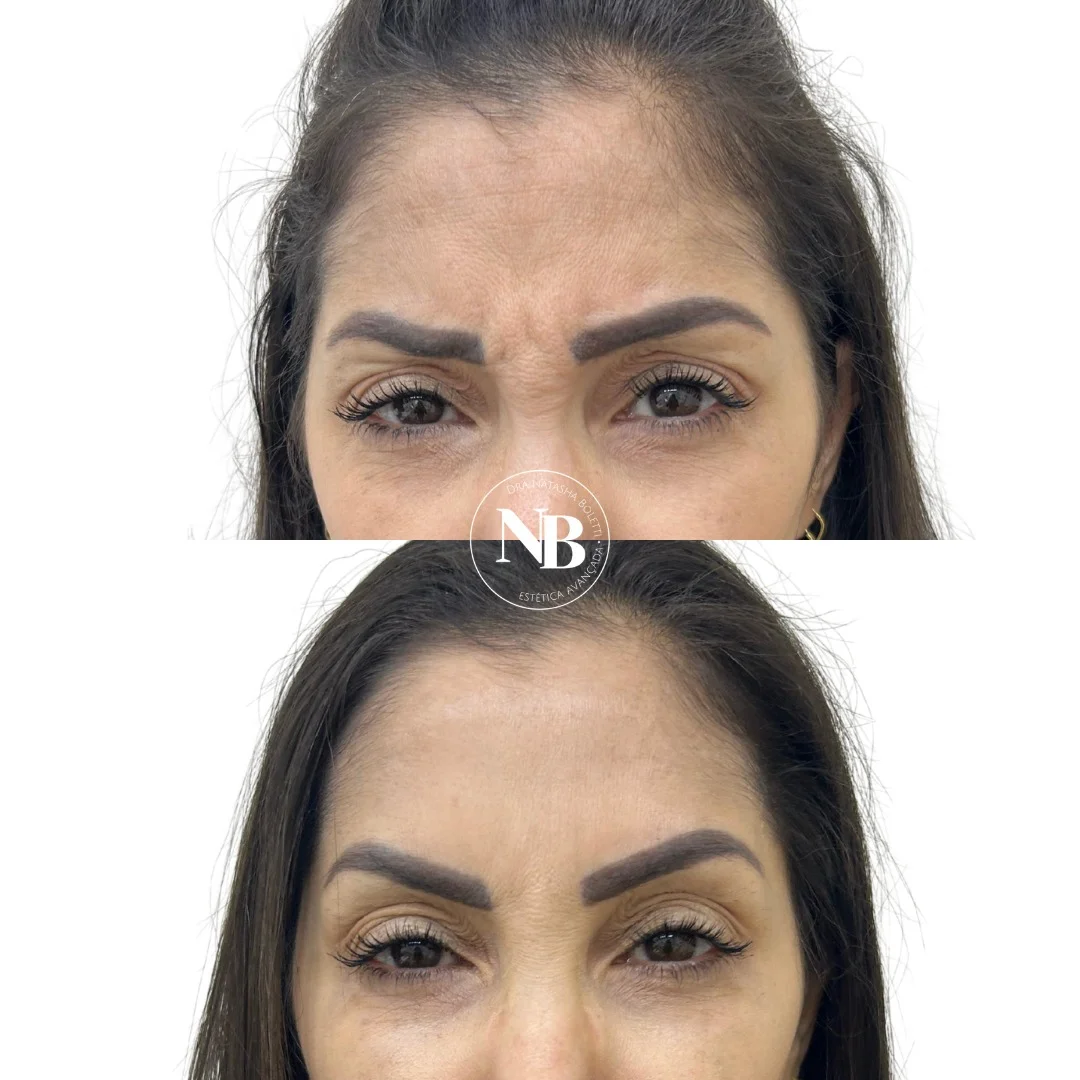antes-depois-nb 05