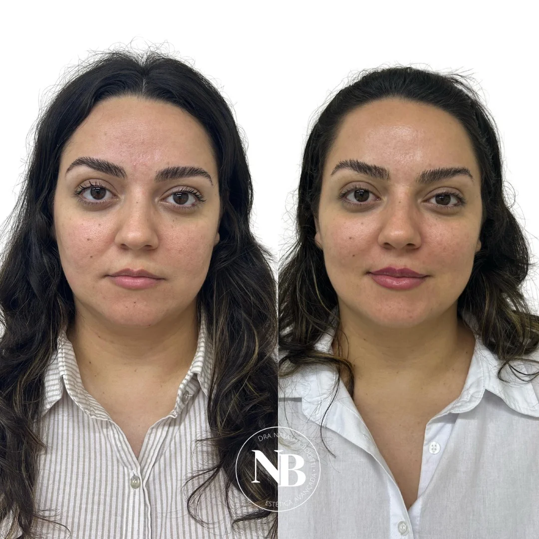 antes-depois-nb 06