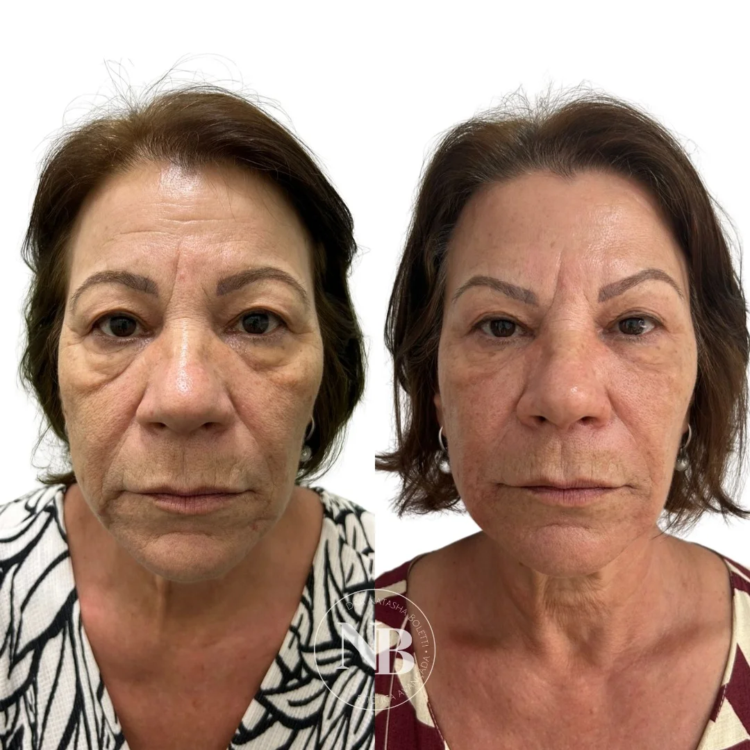 antes-depois-nb 07