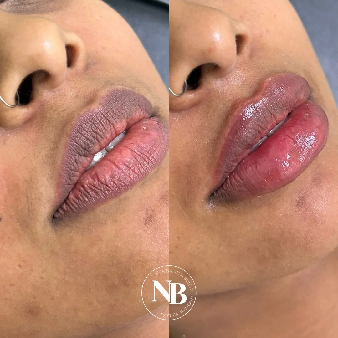 antes-depois-nb 08